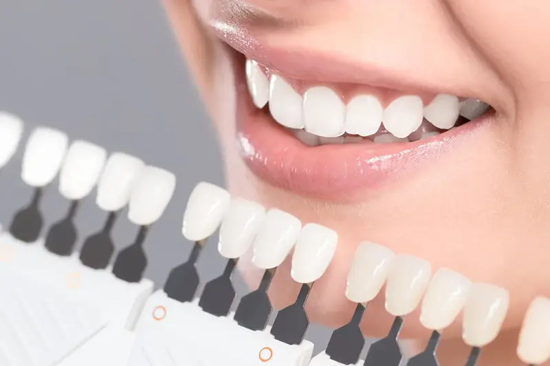 Close up of a person smiling as a dentist holds up tooth color options for treatment